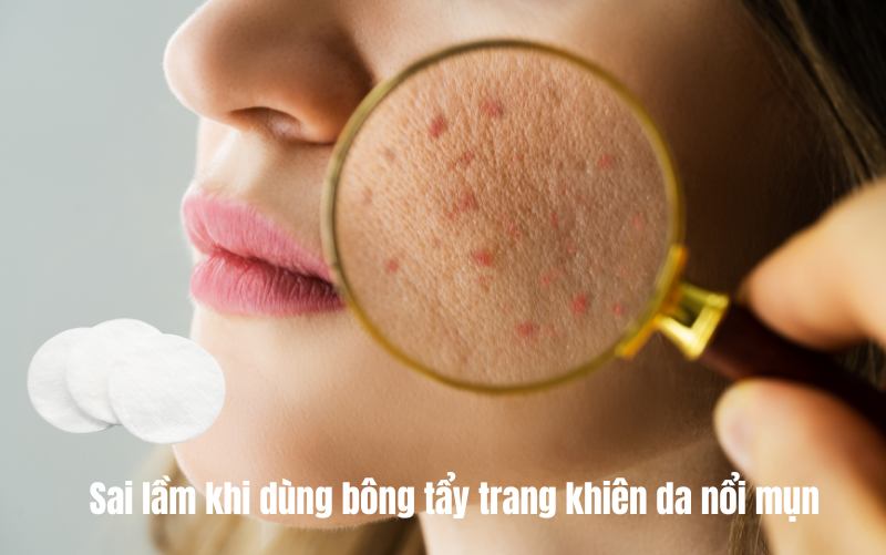 Sai lầm khi dùng bông tẩy trang khiên da nổi mụn